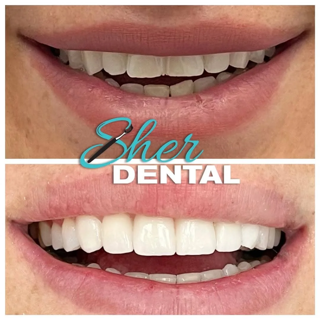 Why Veneers and Smile Makeovers Are Popular in Miami 2025
