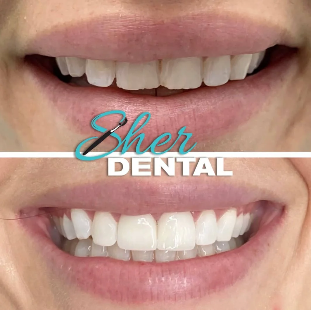 dental implants in Miami FL