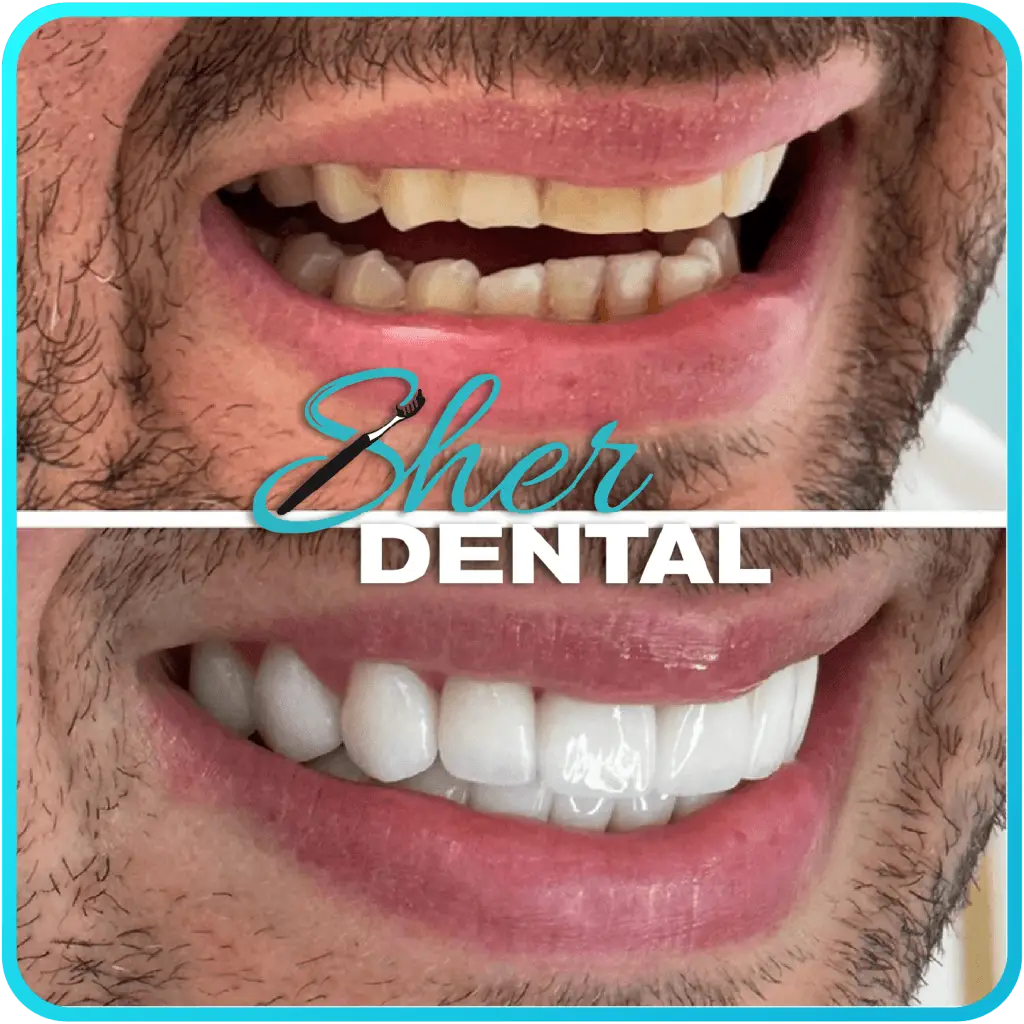 Before and After Onlays & Inlays