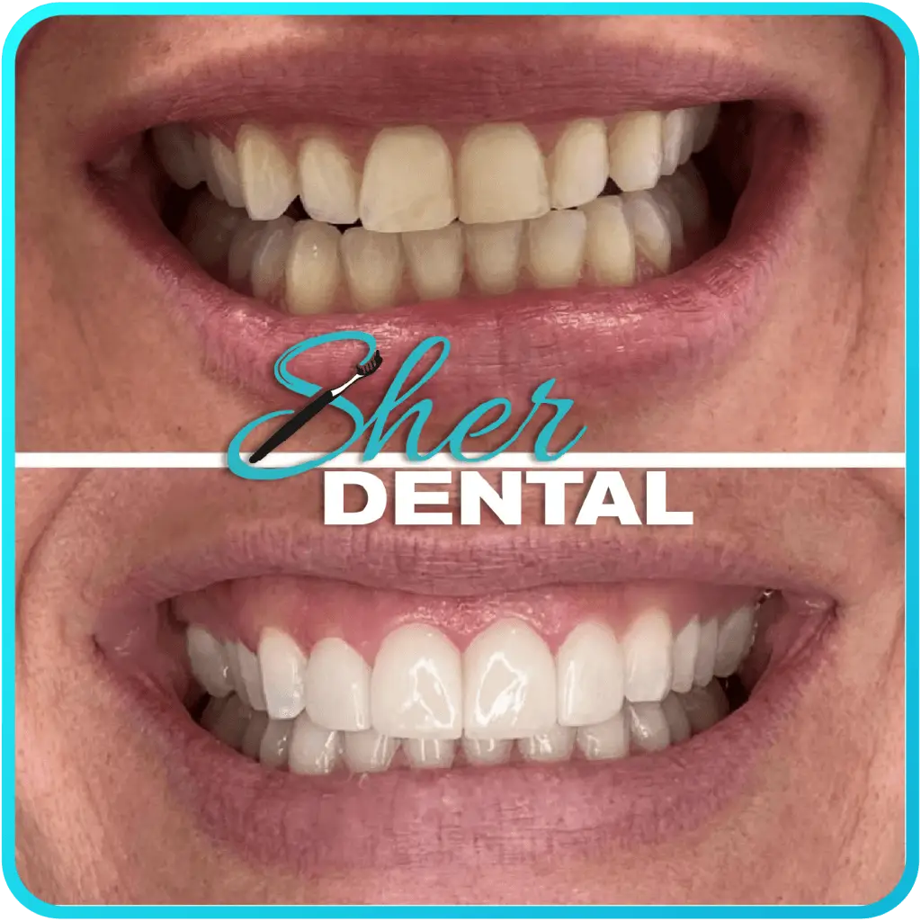 Before and After Root Canal Treatment
