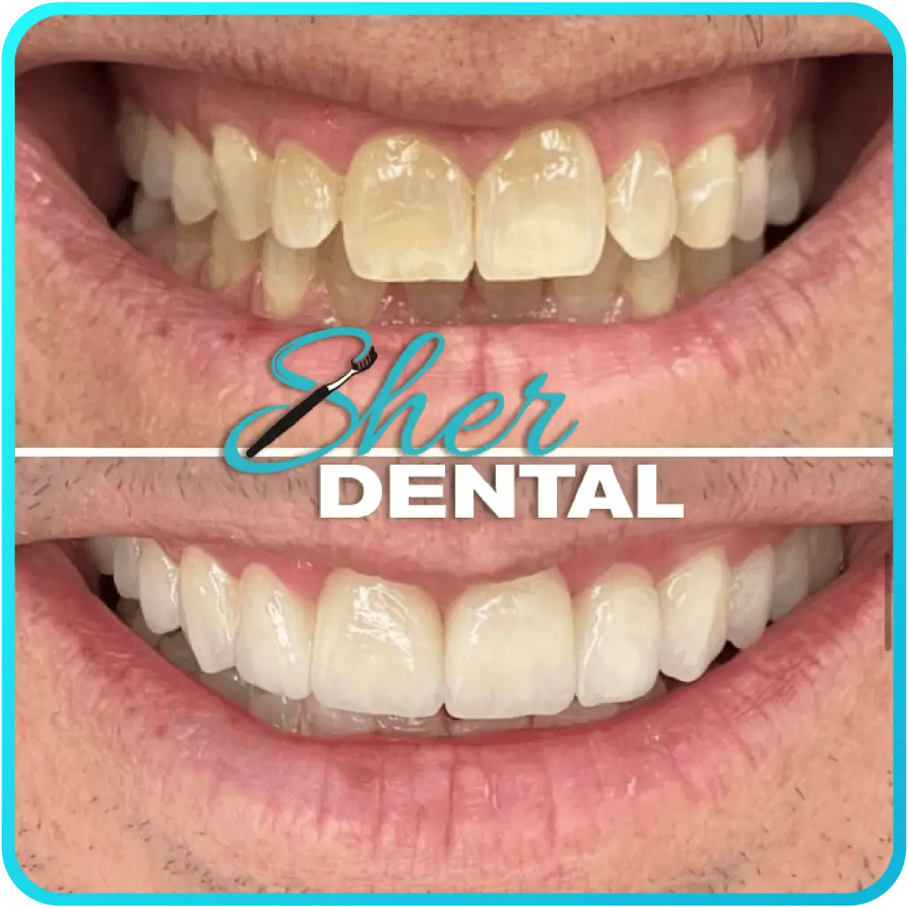 Before and After Root Canal Treatment