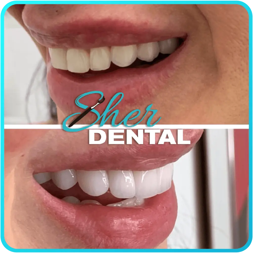 Before and After Dental Fillings