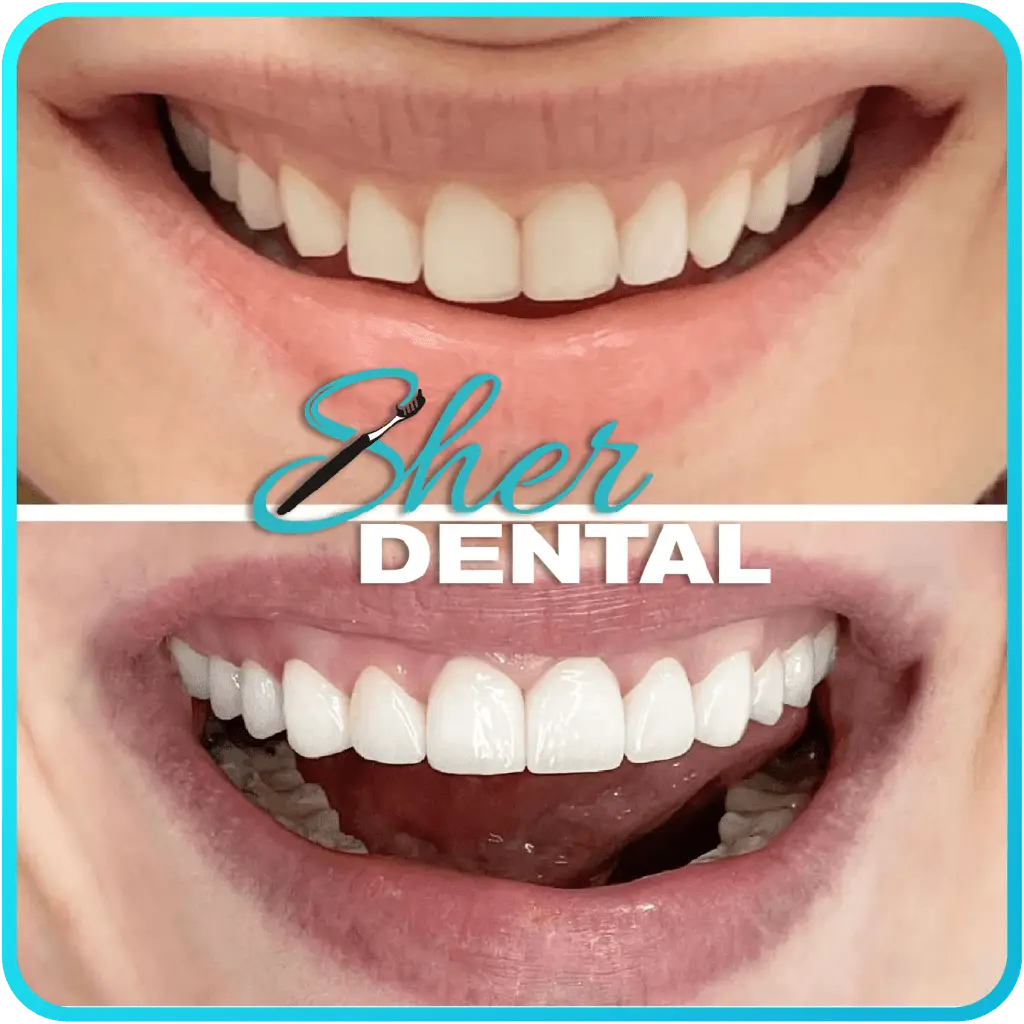 Before and After Root Canal Treatment