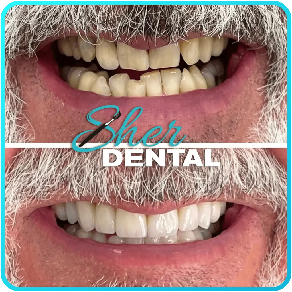 Before and after close-up at Sher Dental - stained and worn teeth restored to a natural white smile