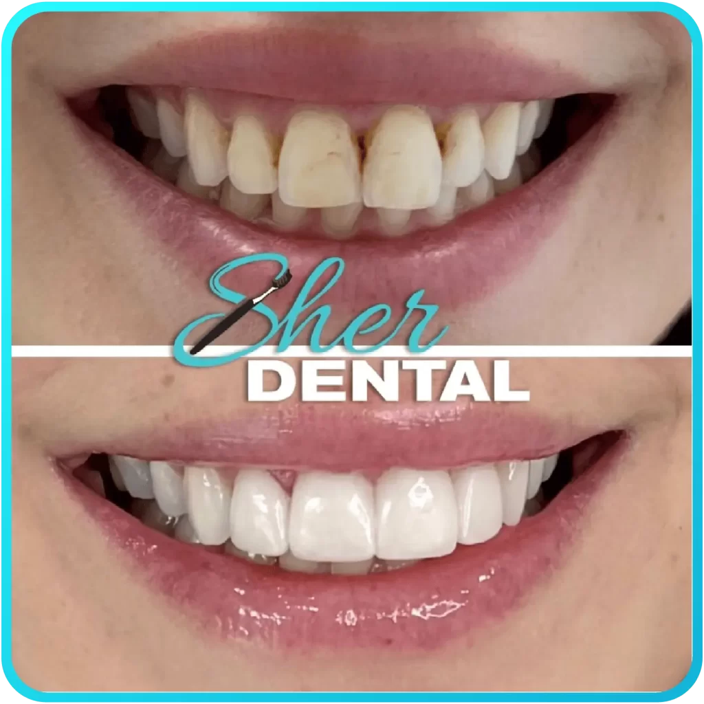 Before and after close-up at Sher Dental - yellowed teeth restored to a brighter, more uniform smile