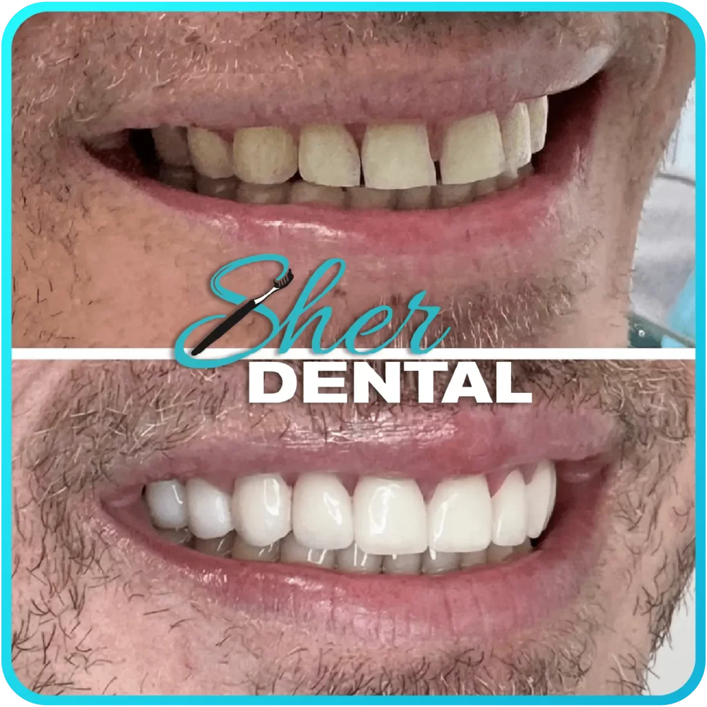 Before and after close-up at Sher Dental - side view of worn teeth restored to an even white smile