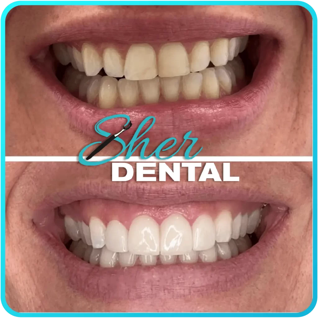 Before and after close-up at Sher Dental - stained and uneven teeth restored to a bright symmetrical smile