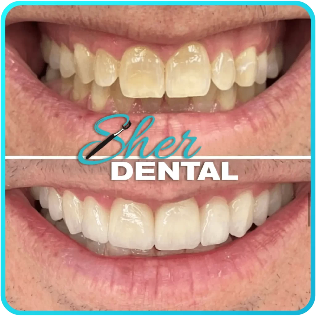 Before and after close-up at Sher Dental - markedly yellowed, irregular teeth restored to a straight white smile
