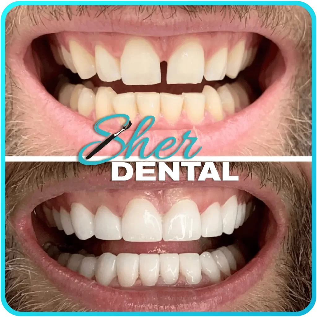 Before and after close-up at Sher Dental - dull, stained teeth restored to a brighter even smile