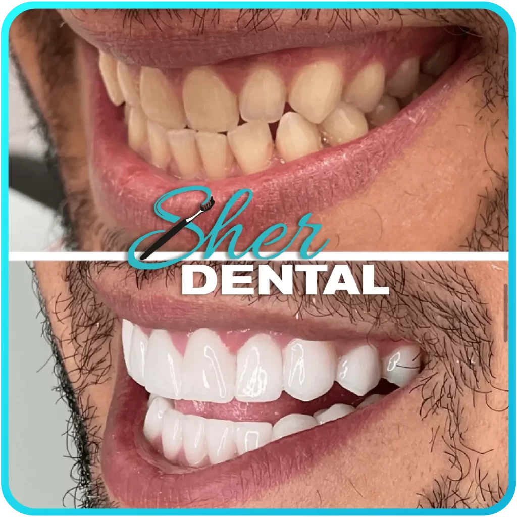 Before and after close-up at Sher Dental - worn and discolored teeth restored to a fuller white smile