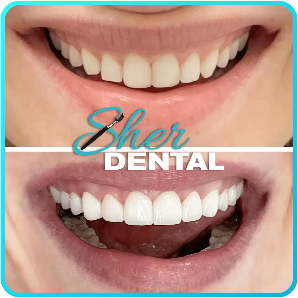 Before and after close-up at Sher Dental - uneven, discolored teeth restored to a symmetrical white smile