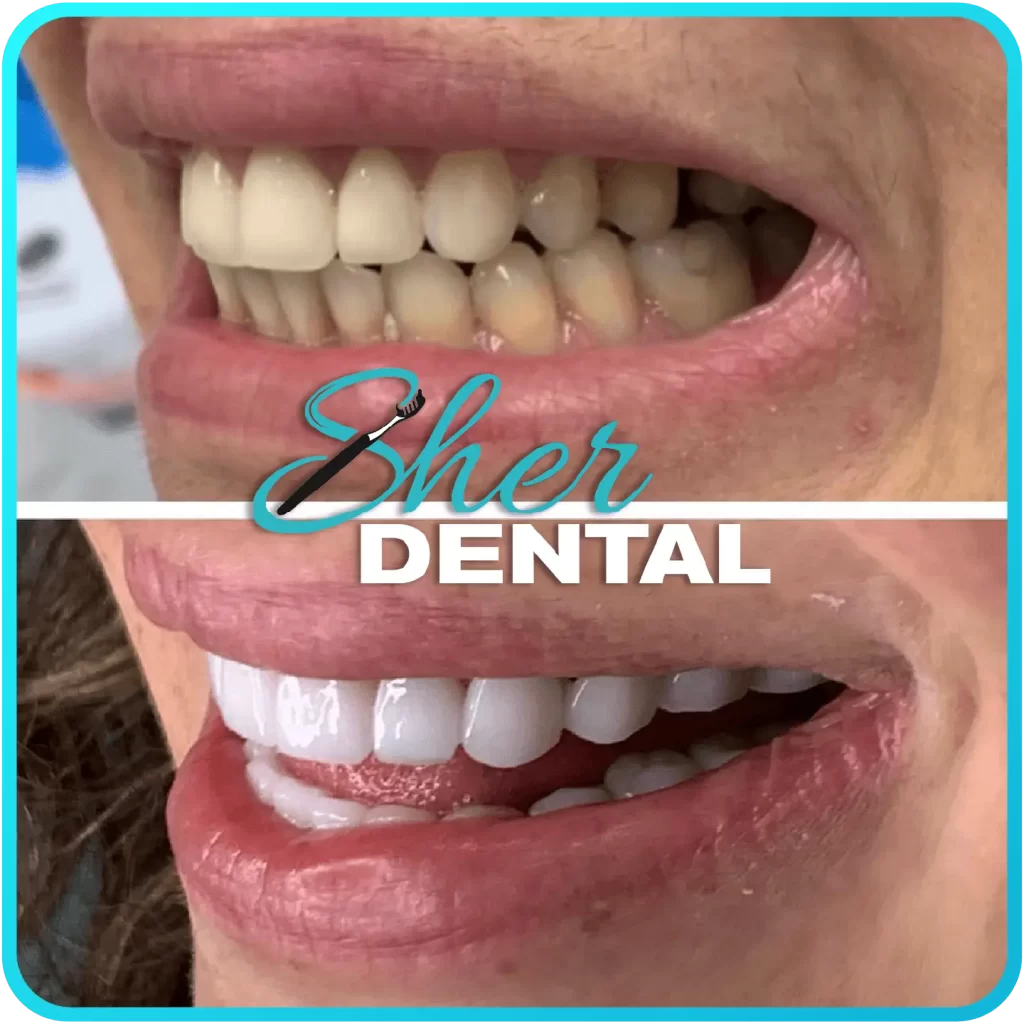 Before and after close-up at Sher Dental - crowded, darkened teeth restored to a straight white smile
