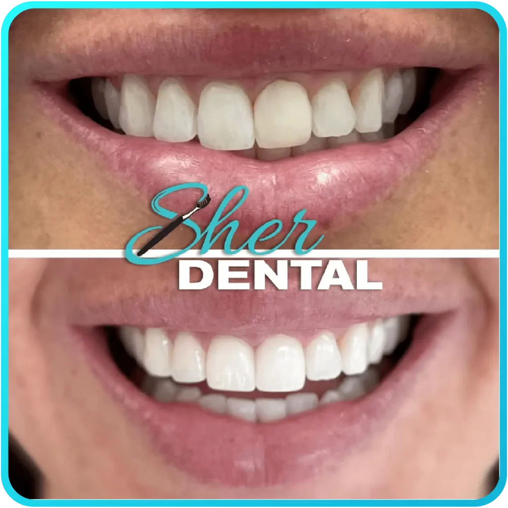 Before and after close-up at Sher Dental - dull, uneven teeth restored to a brighter symmetrical smile
