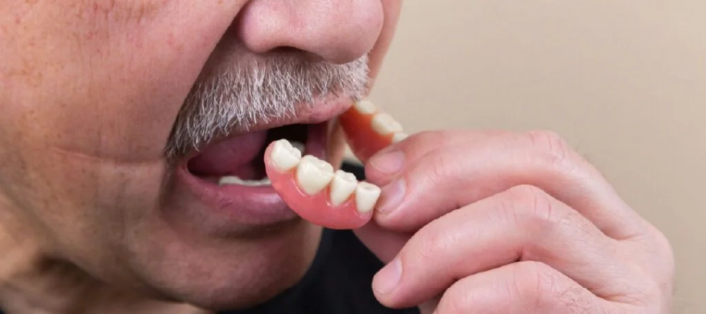 Dental bridge held against a tooth model