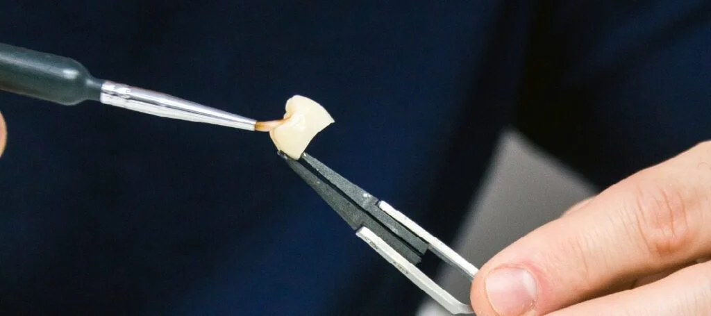 Dental crown being placed on a prepared tooth