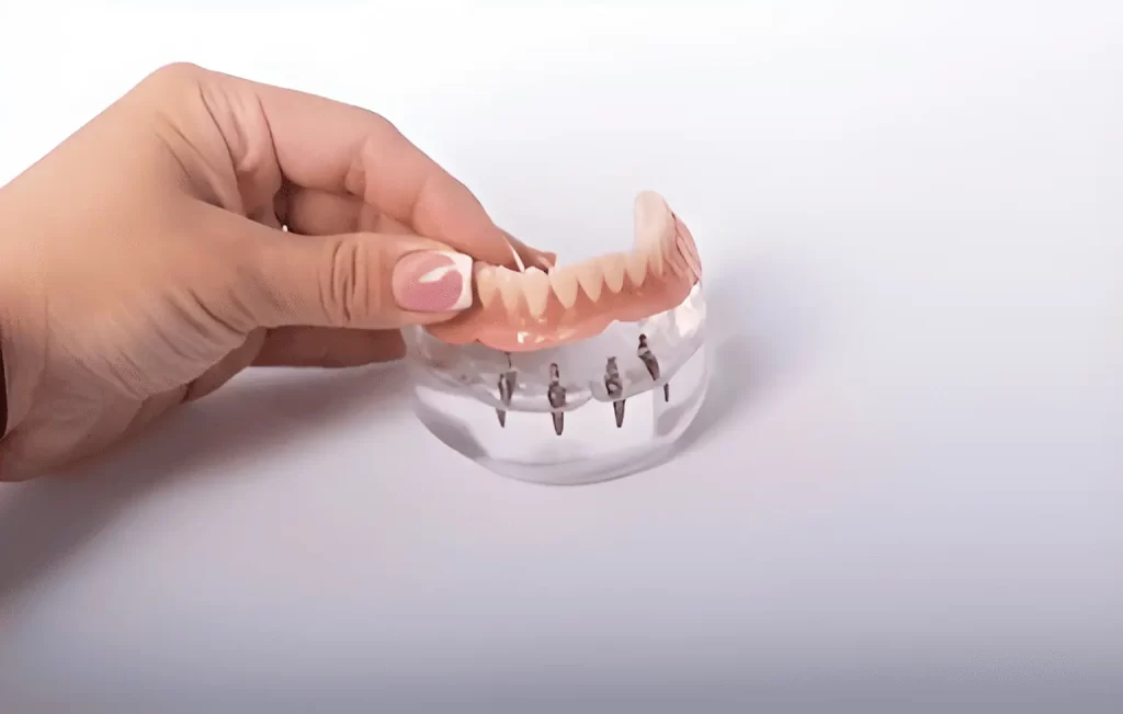 Implant-supported overdenture held in hand