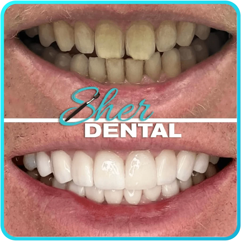 Before and after close-up at Sher Dental - slightly uneven, stained teeth restored to a bright even smile