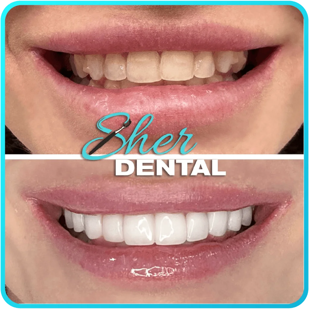 Before and after close-up at Sher Dental - uneven, stained teeth restored to a symmetrical bright smile