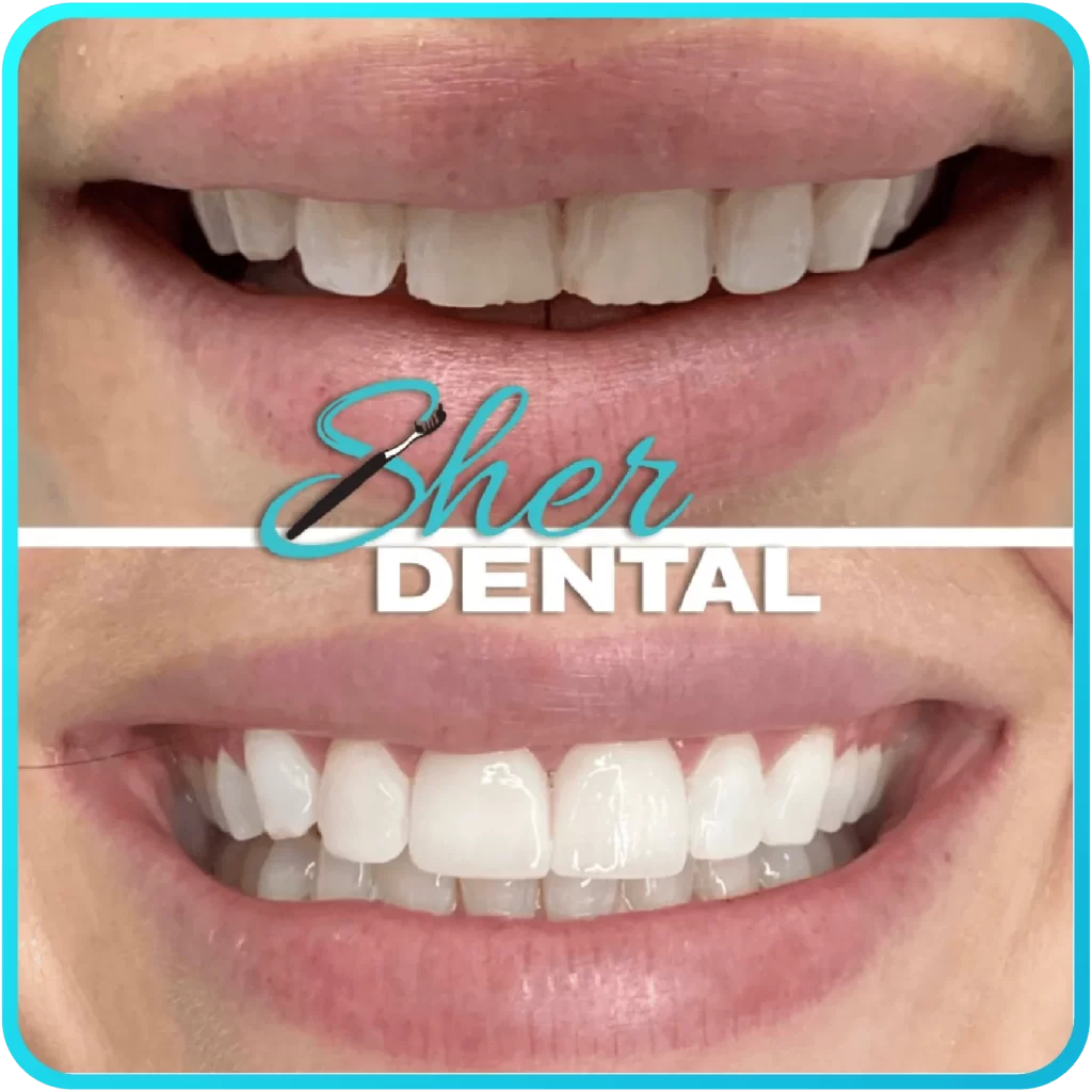 Before and after close-up at Sher Dental - dull, uneven teeth restored to a brighter symmetrical smile