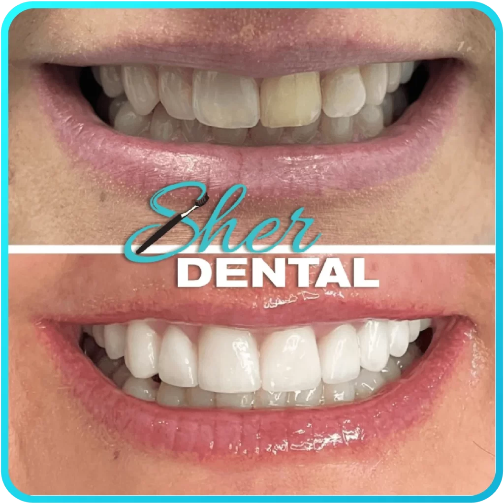 Before and after close-up at Sher Dental - discolored teeth restored to a natural white shade