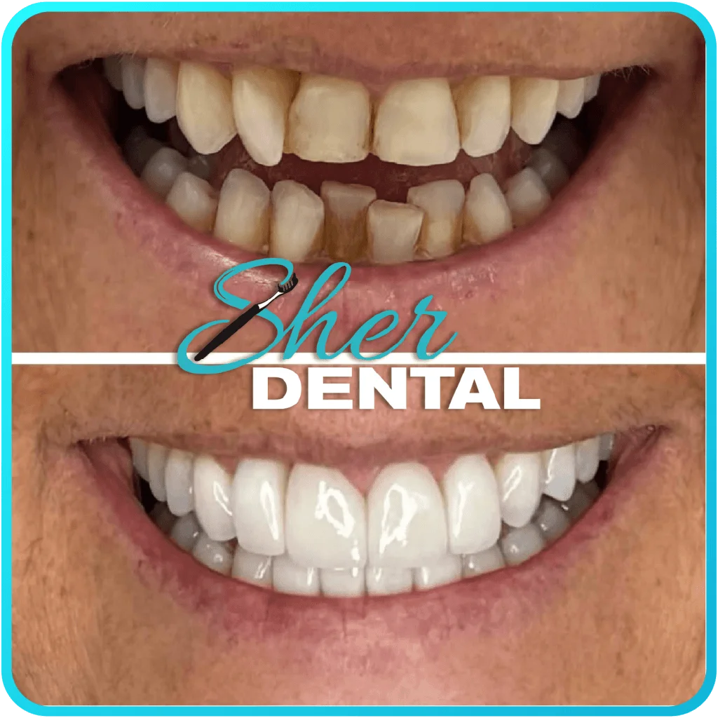 Before and after close-up at Sher Dental - stained teeth with uneven edges reshaped into a smooth smile line