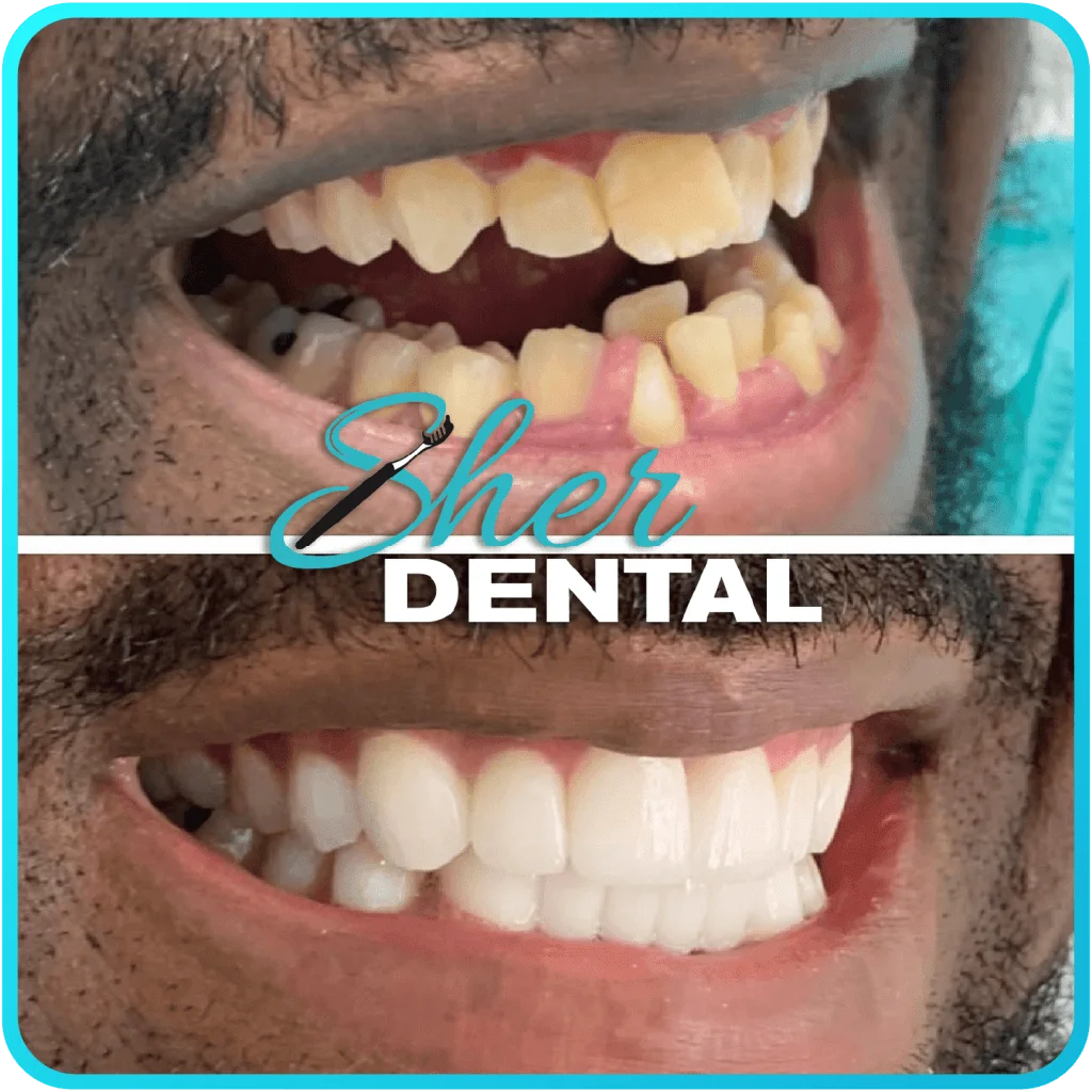 Before and after close-up at Sher Dental - crowded, yellowed teeth restored to a straight white smile