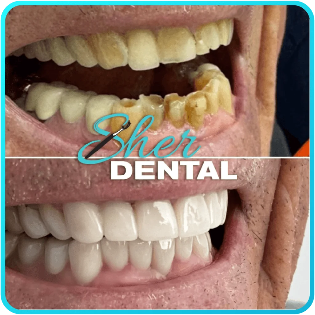 Before and after close-up at Sher Dental - heavily stained and worn teeth fully restored