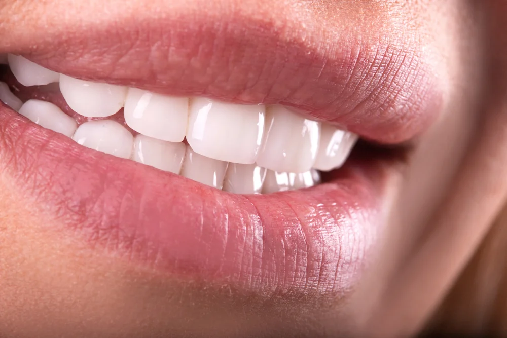 Dental Bridges Miami