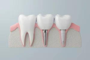 Dental Implants