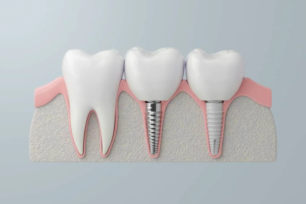 Dental Implants