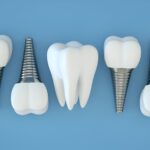 Dental implant consultation for missing tooth replacement in Miami
