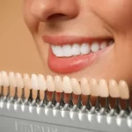 Porcelain veneers in Fort Lauderdale
